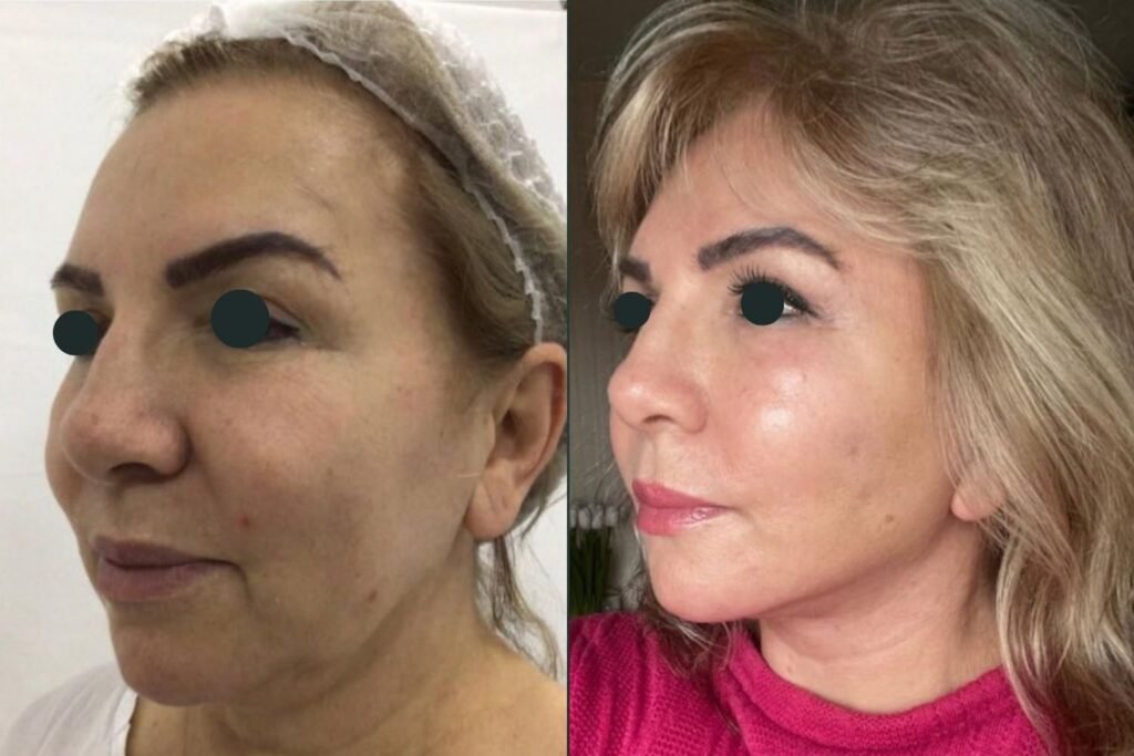 Before and after_Belvivere