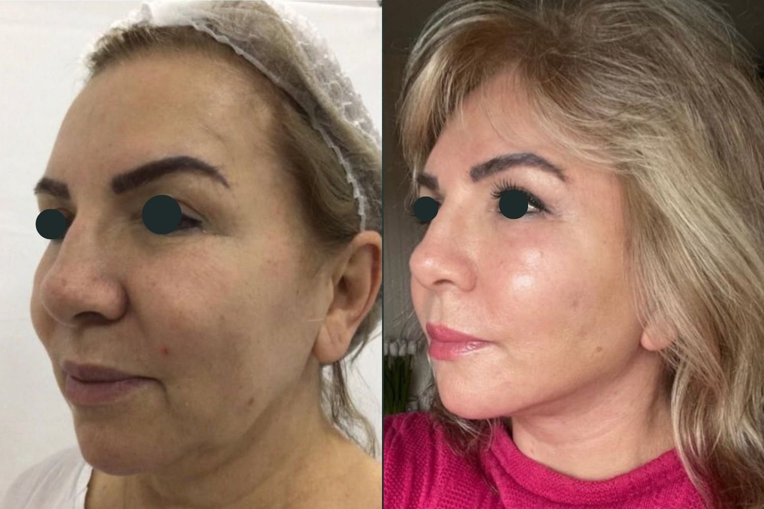 Before and after_Belvivere
