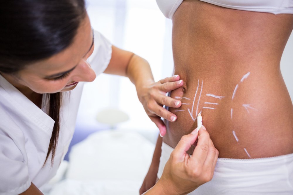 Does Abdominoplasty Leave the Abdomen Flat?